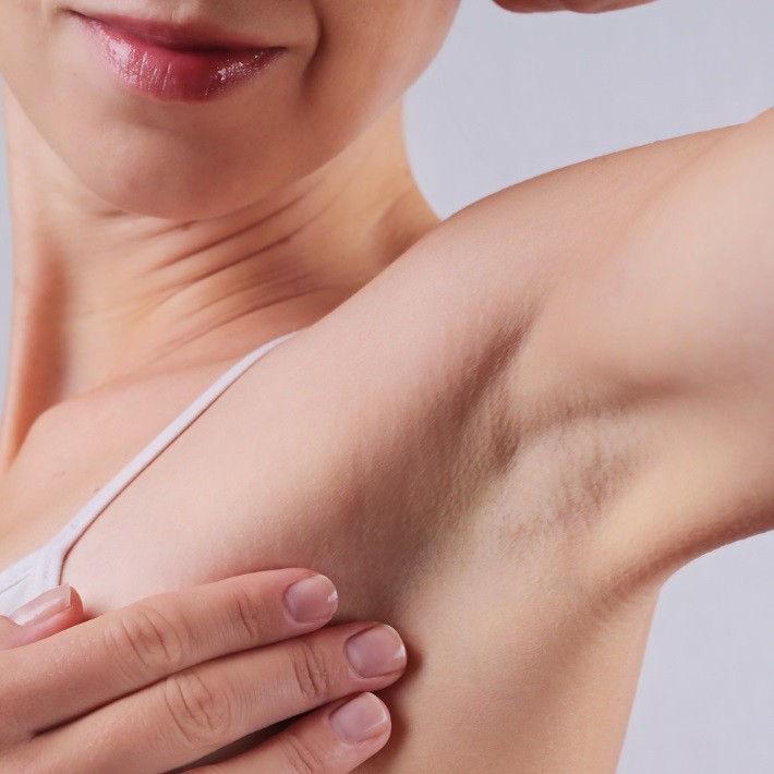 Consider Before Laser Hair Removal